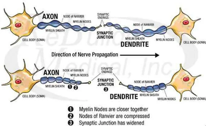 What-happens-to-nerves-when-deprived-of-oxygen--Actual-shrinkage-of-nerve-cells-resulting-in-widened-synaptic-junction Acupuncture treatment for Peripheral Neuropathy: What happens to nerves when deprived of oxygen? Actual shrinkage of nerve cells resulting in widened synaptic junction.